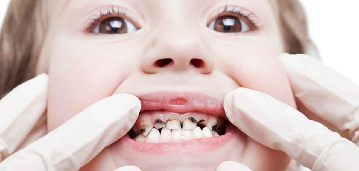 उपत्यकामा ७३ प्रतिशत बालबालिकामा दाँत किराले खाने समस्या